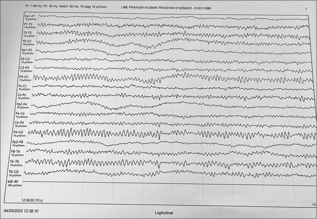 Normal electroencephalogram following normalization of blood glucose.