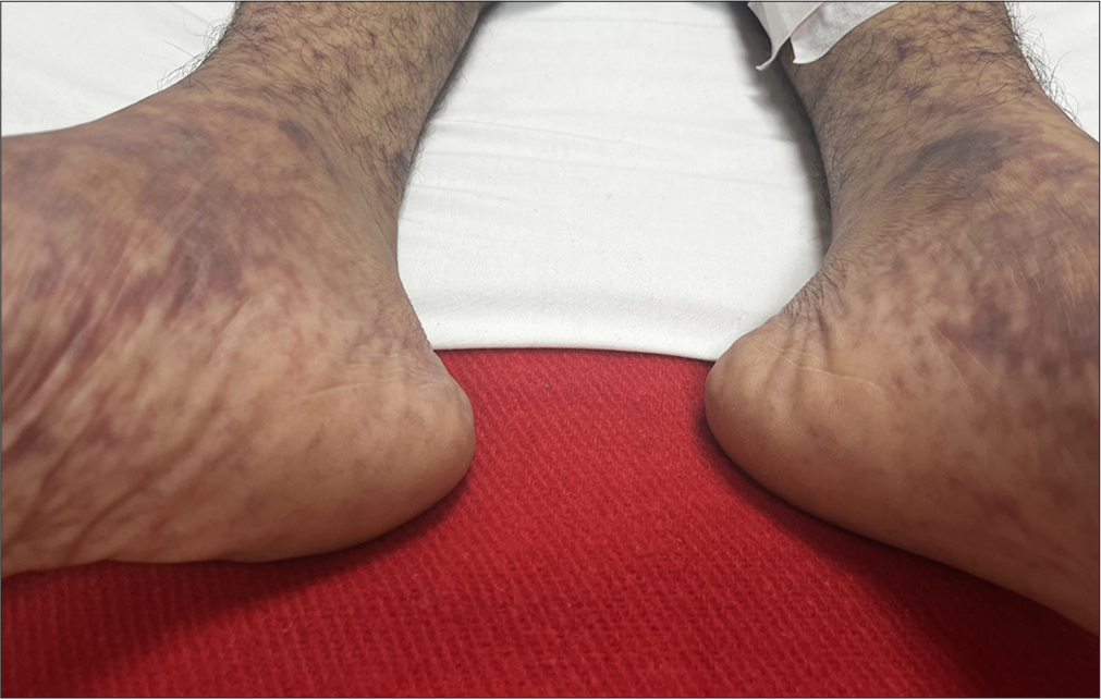 Non-blanchable petechial rash on the lower limbs.