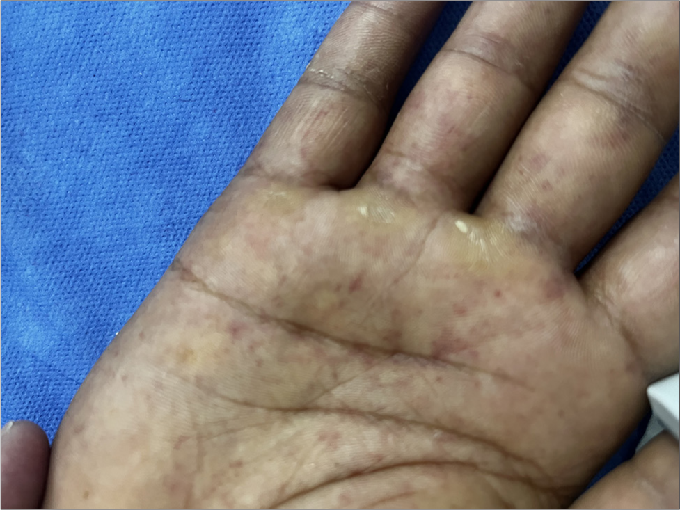 Janeway lesions on the palms.