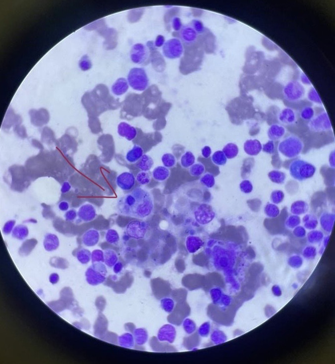 Bone marrow aspiration histology showed evidence of hemophagocytes (red arrow).